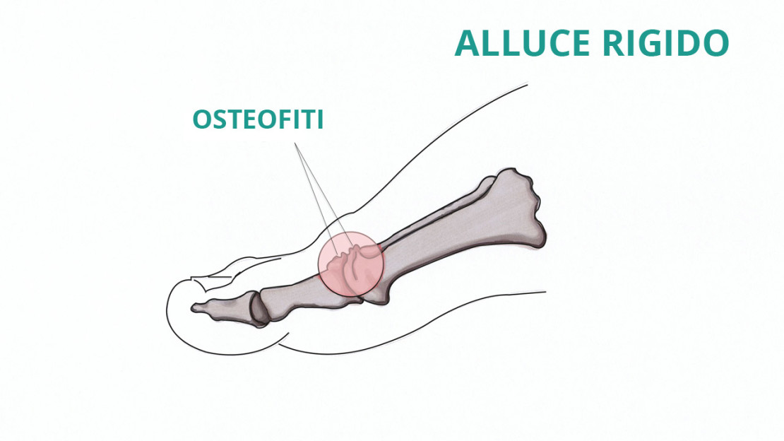 alluce-rigido